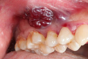 Cancerous lesion in mouth